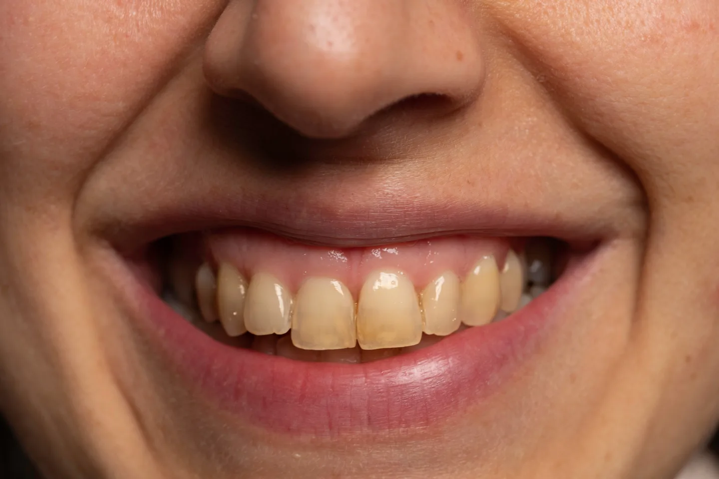 Cómo blanquear tus dientes naturalmente