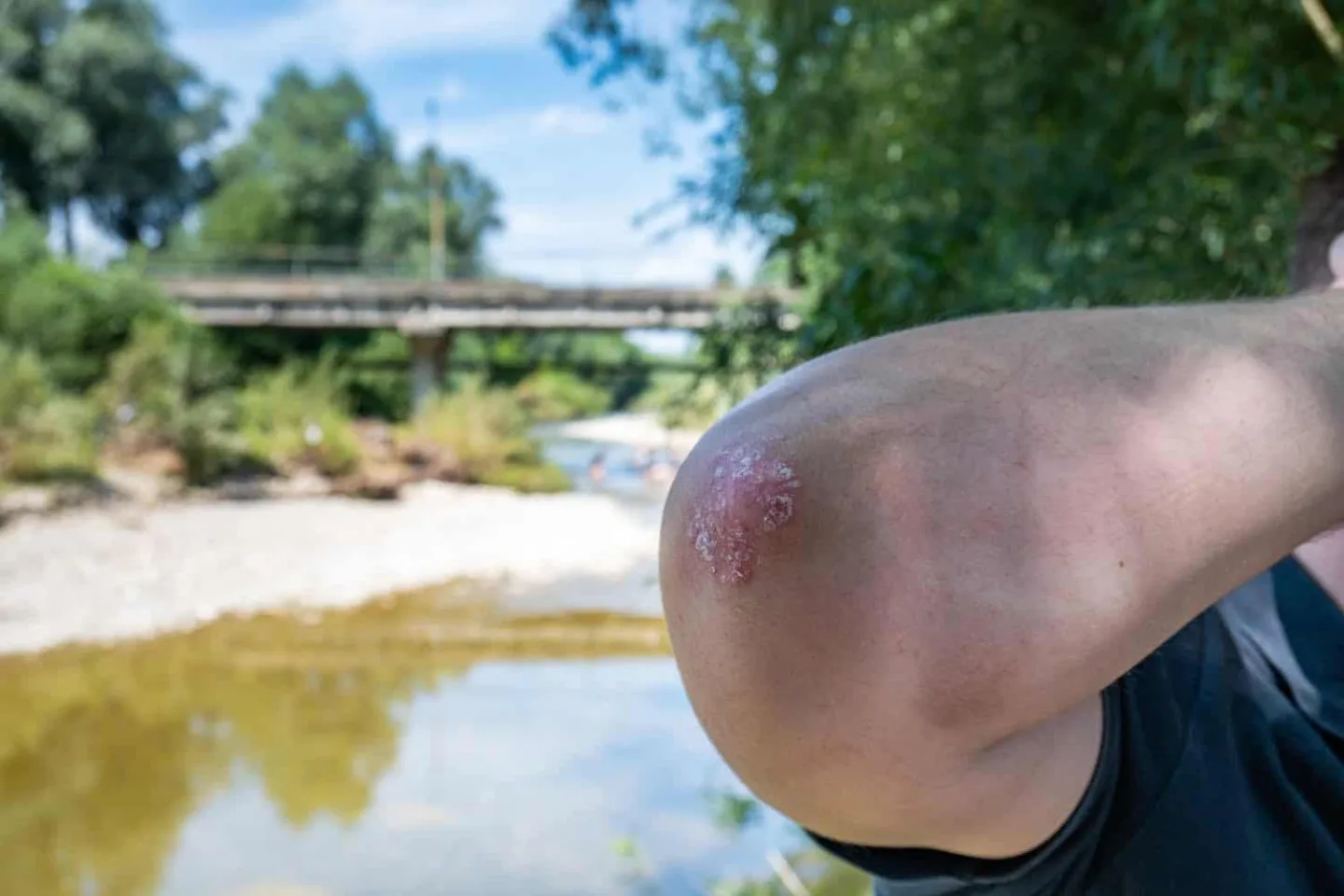 Eczema