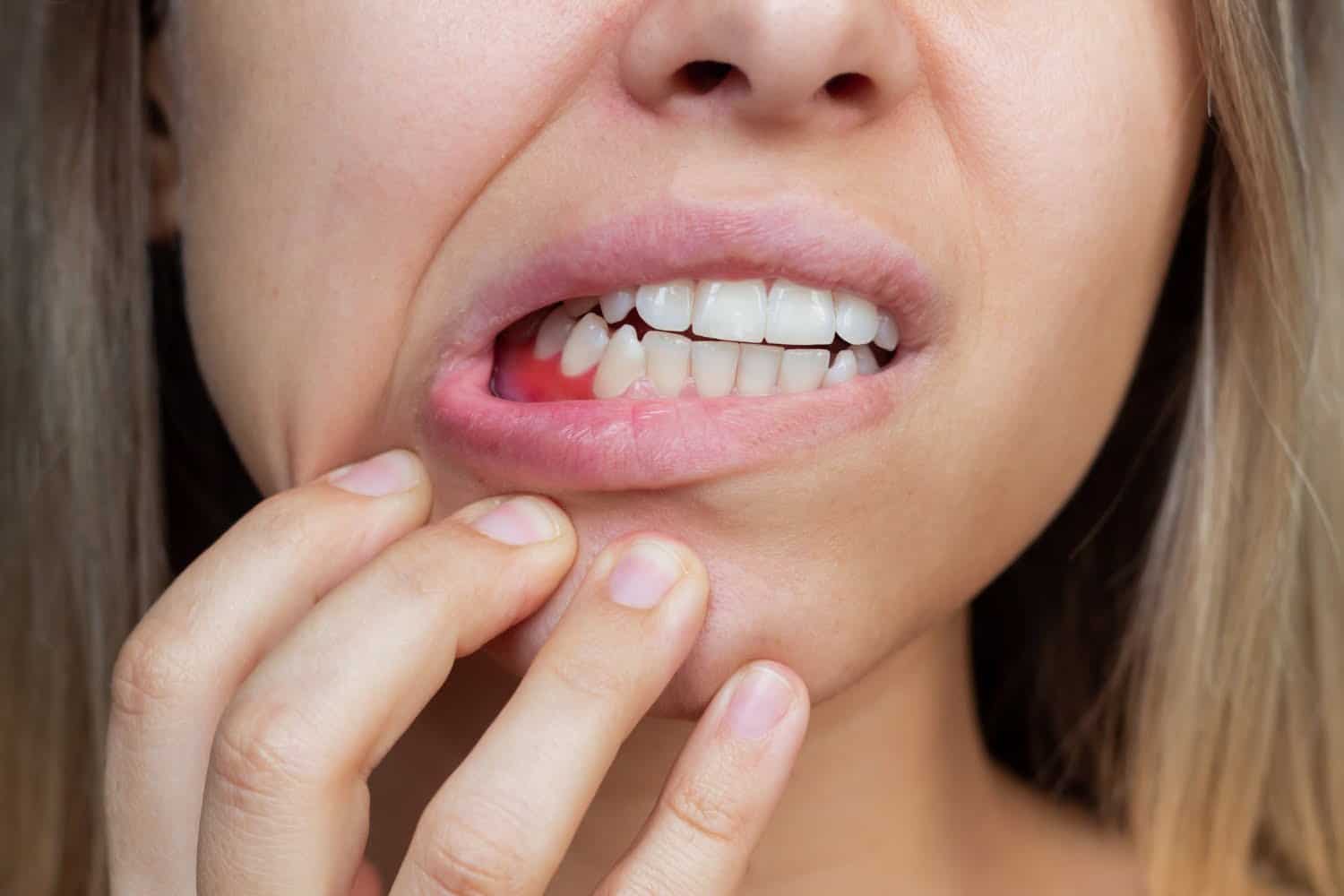Úlceras bucales, gingivitis y enfermedad periodontal: Tratamientos naturales