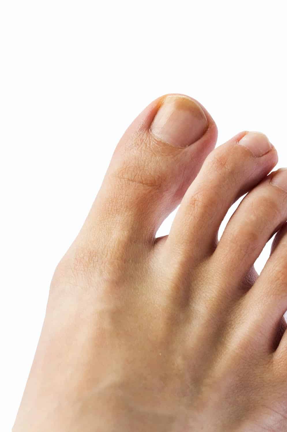 Transmisión de los hongos de las uñas y cómo prevenirlos