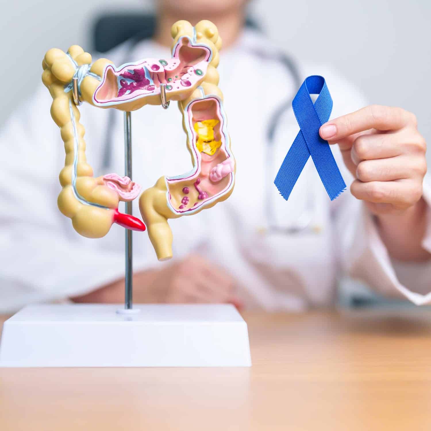 El aumento alarmante del cáncer colorrectal en jóvenes