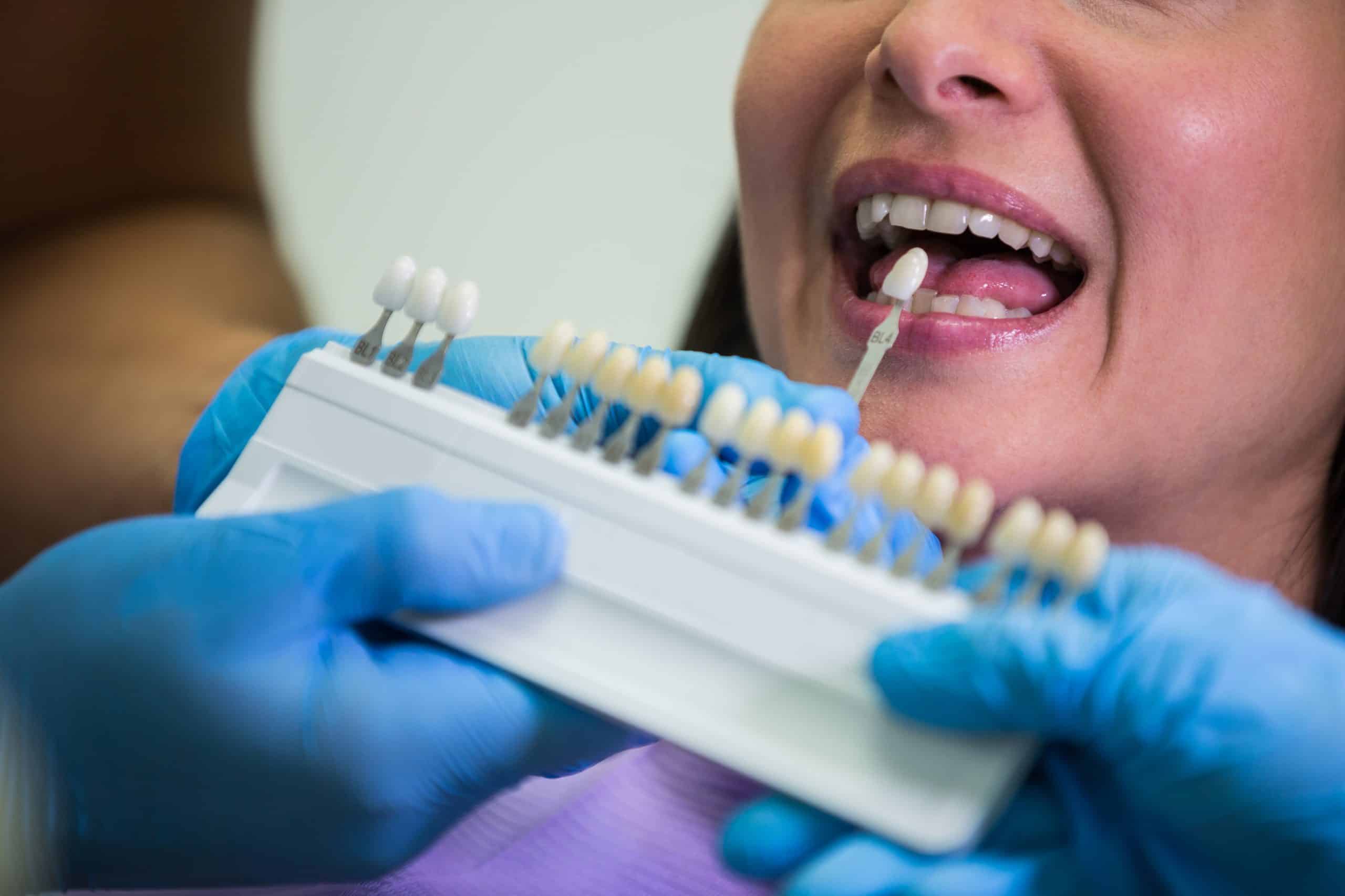 implantes dentales